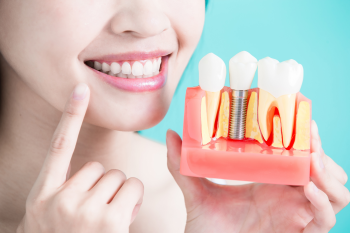 Implantuoti nereikia laukti: odontologė atsakė, kurioje vietoje ir kodėl geriau dėti kablelį